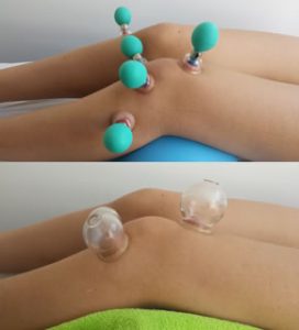 Ventouses / cupping